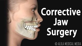 Corrective Jaw Orthognathic Surgery Animation [upl. by Annalise]