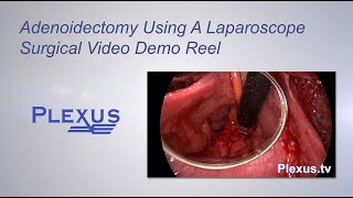 Adenoidectomy Surgical Video [upl. by Aldin]