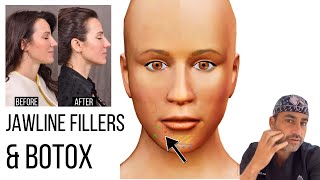 Jawline Fillers amp Botox Tips  What to Know  Beverly Hills Facial Plastic Surgeon Dr Ben Talei [upl. by Latsyrd]