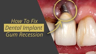 Fix Dental Implant Gum Recession [upl. by Ranite]