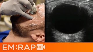 Ultrasound of Retinal vs Vitreous Detachment [upl. by Aihsat]