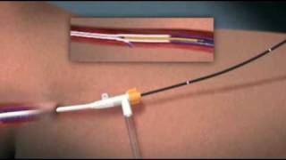 Animation of Endovenous Radiofrequency Ablation of Varicose Vein [upl. by Nahgeem]