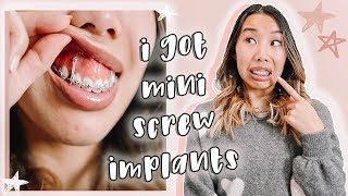 I GOT IMPLANTS My TADs Experience Braces Update [upl. by Rochemont328]