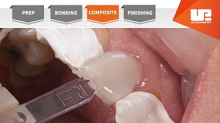 Composite  Your Complete Restorative Solution [upl. by Ffilc747]