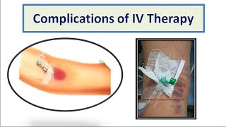 Intravitreal Injection Animation HD [upl. by Neit]