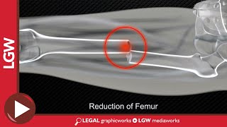 Midshaft Femur Fracture Intramedullary Nailing 3D Animation [upl. by Hpseoj]