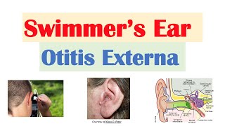 Swimmer’s Ear Otitis Externa  Risk Factors Causes Signs amp Symptoms Diagnosis Treatment [upl. by Hajile]