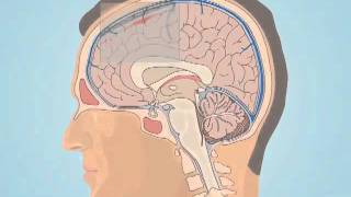 Understanding Subarachnoid Hemorrhage [upl. by Shirleen513]