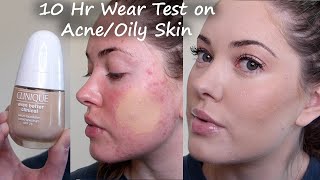 New Clinique Even Better Clinical Serum Foundation WEAR TEST on acne prone amp oily skin cn 08 linen [upl. by Oigaib]