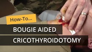 Bougie Aided Cricothyroidotomy [upl. by Eseilenna435]