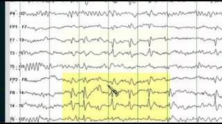 Intracranial EEG for Epilepsy  Mayo Clinic [upl. by Robert478]