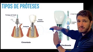 Tipos de prótese em Implantodontia  Cimentadas Parafusadas Unitárias ou Múltiplas [upl. by Snell]