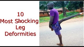 10 Most Shocking Leg Deformities [upl. by Crespo]