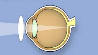 Retinoscopy of the eye Ophthalmology [upl. by Adnarim]