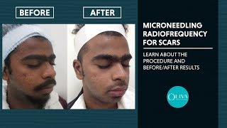 Microneedling RadiofrequencyRF Treatment Before And After Results  Oliva Clinic [upl. by Elsilrac448]