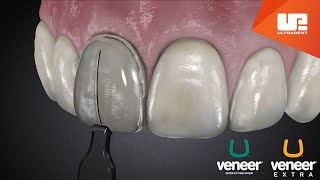 Uveneer® Procedure Animation  Direct Veneer Template System [upl. by Gustave374]