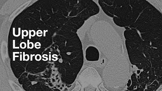 Upper Lung Predominant Fibrosis [upl. by Chiles]