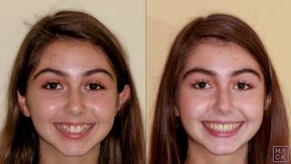 Braces Before and After with Reshaping of Front Teeth [upl. by Nired]