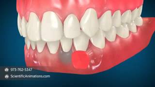 Gum Grafting Surgery  Dental Animation [upl. by Leelaj]