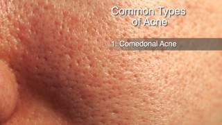 How to Treat Different Types of Acne [upl. by Henka]