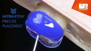 Precise Placement with UltraEtch Etchant [upl. by Addia]