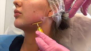 Jawline Filler London  by Dr Leah Totton [upl. by Vera]