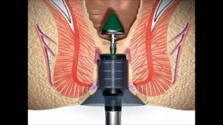 Stapled Haemorrhoidectomy using the PPH System  English [upl. by Huxley]