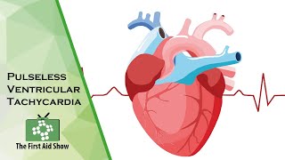 Pulseless Ventricular Tachycardia [upl. by Fital321]