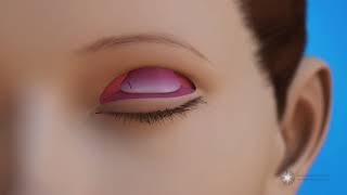 Levator Resection for Ptosis Repair Surgery Eyelid Lift [upl. by Aznerol]