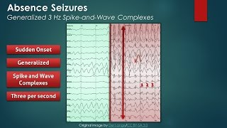 Absence Seizures EEG Findings [upl. by Kalasky692]