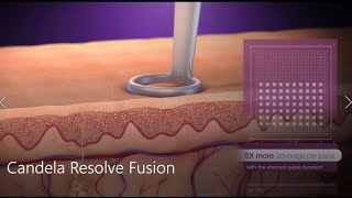 Acne Scar and Wrinkle Treatment by Candela 3D medical animation [upl. by Miquela]