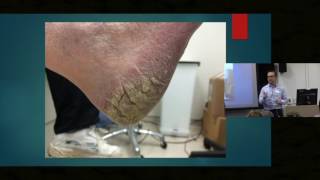 Itch in Elderly Skin  Dr Ian Bekker [upl. by Chiquia]