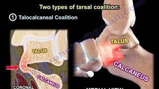 Tarsal Coalition  Everything You Need To Know  Dr Nabil Ebraheim [upl. by Press]