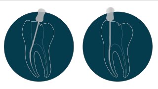 Preparo do terço cervical em Endodontia [upl. by Ecirtnahc292]