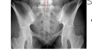 Sacrum Coccyx and SI Joints [upl. by Tsui]