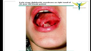 Diphtheria  Causes  Epidemiology  clinical types  Treatment [upl. by Onitsuaf]