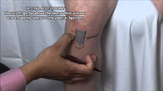 Knee Injection  Anterior Approach [upl. by Leah311]