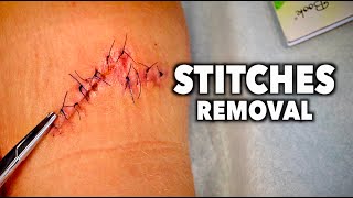 REMOVING 13 STITCHES From a Huge Leg Wound  Dr Paul [upl. by Hedges]