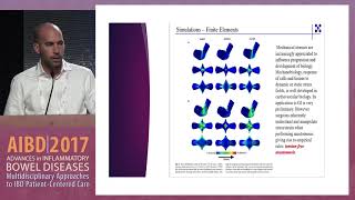 IBD Surgery Small bowel resectionstricturoplasty [upl. by Novyat]