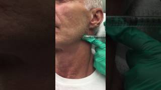 Juvederm Voluma Filler for the Jawline [upl. by Fonsie888]