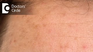 What is Hyperpigmentation and how to treat it  Dr Jyoti Jha [upl. by Jasisa]