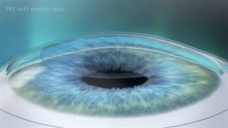 Photorefractive Keratectomy PRK Laser Eye Surgery [upl. by Auka703]