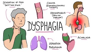 Approach to dysphagia difficulty swallowing  causes pathophysiology investigation [upl. by Lesna]