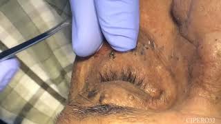 Milia  Stringoma Removal  Periorbital Area [upl. by Naletak628]