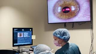 Live PRK Procedure at Commonwealth Eye Surgery [upl. by Lahtnero57]