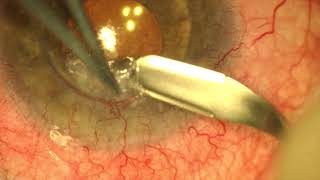 Techniques to Open DMEK grafts corneal endothelial transplantation [upl. by Strohbehn608]