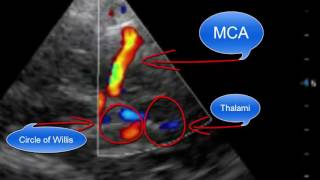 Pointofcare Transcranial Doppler [upl. by Laud]