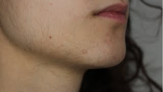 UPDATE 1 FACIAL HAIR ELECTROLYSIS VS LASER HAIR REMOVAL  PCOS [upl. by Kaitlynn837]