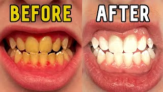 How I Whitened My Teeth in 14 Days [upl. by Bonnes]