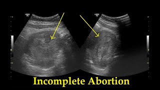 Incomplete Abortion  Ultrasound  Case 25 [upl. by Arodaeht13]